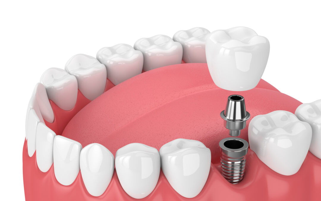 ¿Qué es un implante dental?